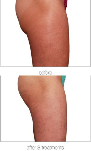 venus legacy before and after