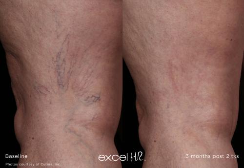 laser vein removal miami