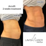 accufit before and after