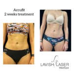 accufit before and after