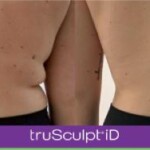 trusculpt id before and after