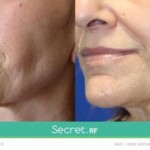 secret rf before and after