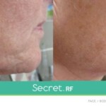secret rf before and after