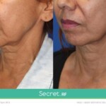 secret rf before and after