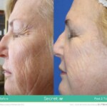 secret rf before and after