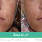 secret rf before and after