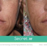 secret rf before and after