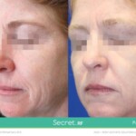 secret rf before and after
