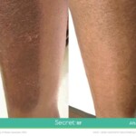 secret rf before and after