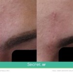 secret rf before and after