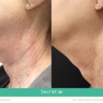 secret rf before and after