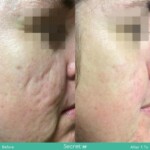 secret rf before and after