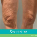 secret rf before and after