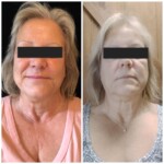 secret rf before and after