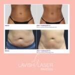 truSculpt iD before and after