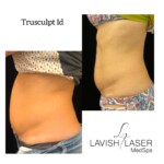 truSculpt iD before and after