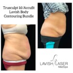 truSculpt iD before and after