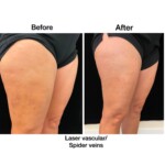 spider vein removal before and after