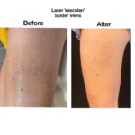 vein removal before and after