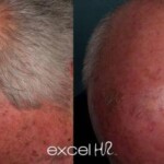 pigment removal before and after