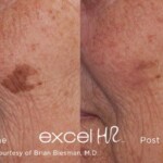 pigment removal before and after