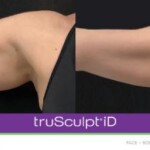 trusculpt id before and after