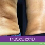 trusculpt id before and after