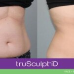 trusculpt id before and after