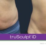 trusculpt id before and after