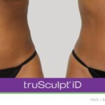 trusculpt id before and after