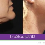 trusculpt id before and after