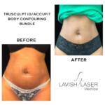 accufit before and after