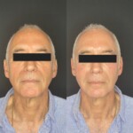 sculptra before and after